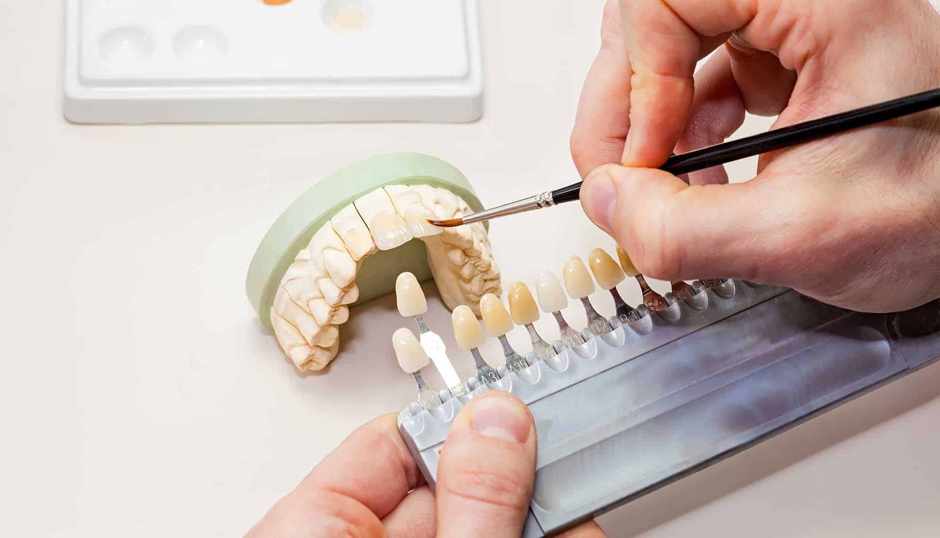 types of dental restoration
