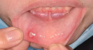 mouth ulcer vs canker sore