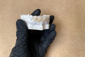 teeth-model-with-veneers
