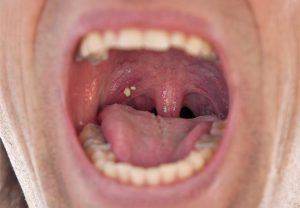 tonsil-stones