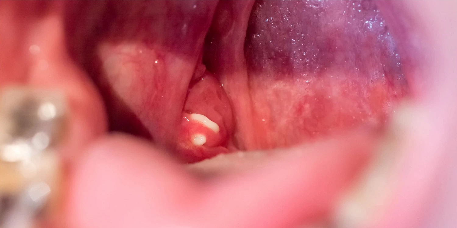 tonsil stone in an open mouth