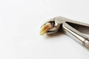 how-long-is-wisdom-teeth-removal