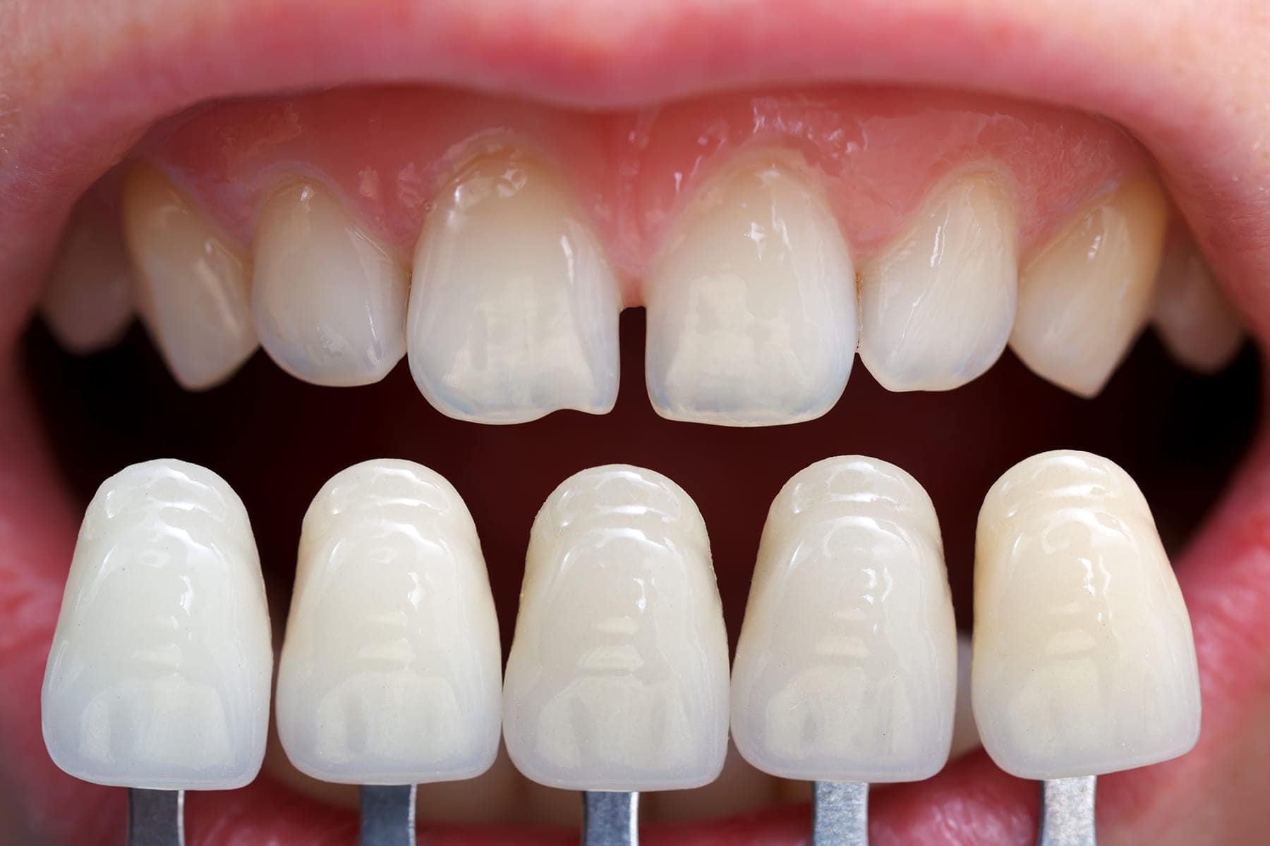 DENTAL VENEERS