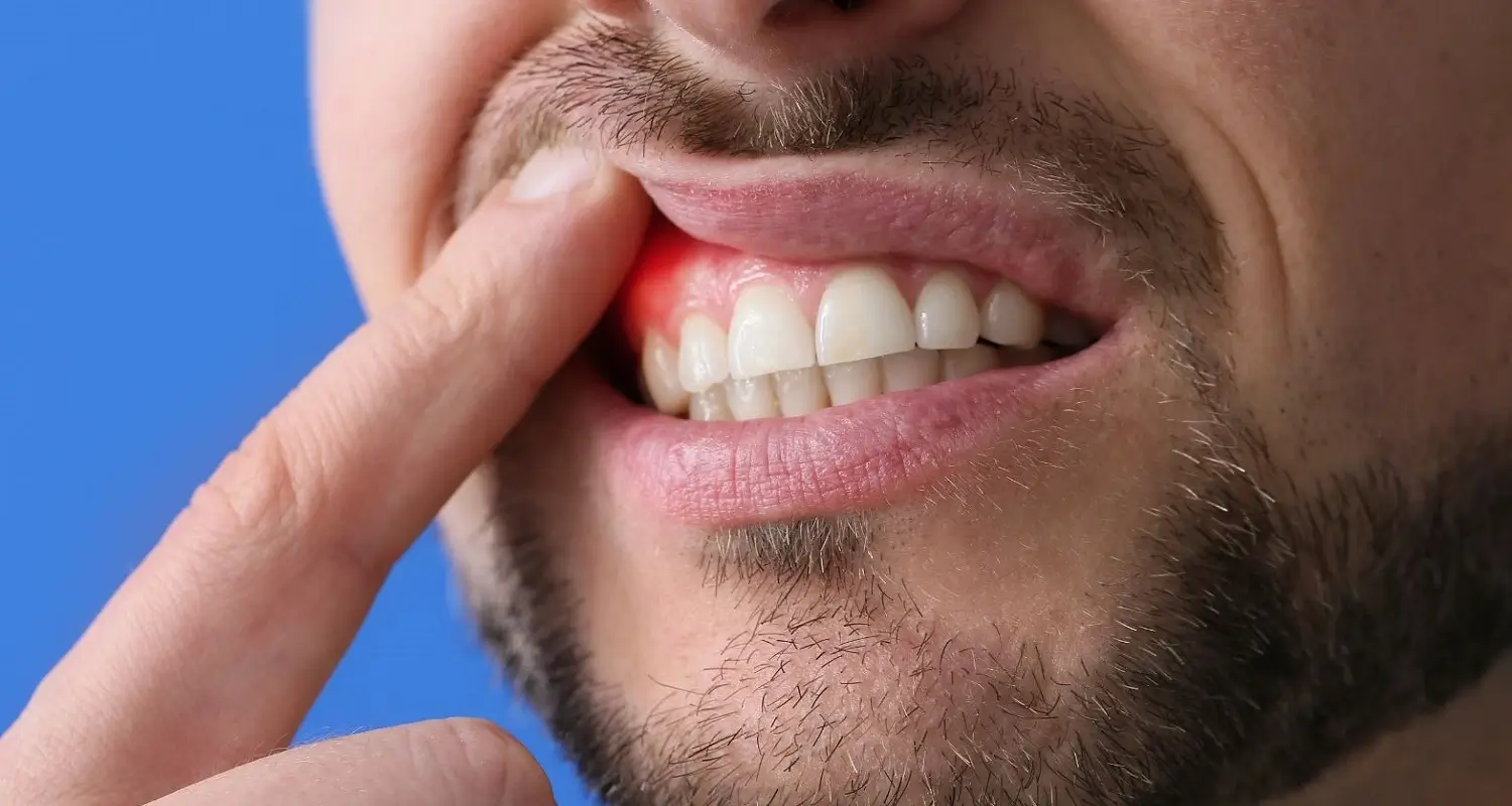 what is dental abscess