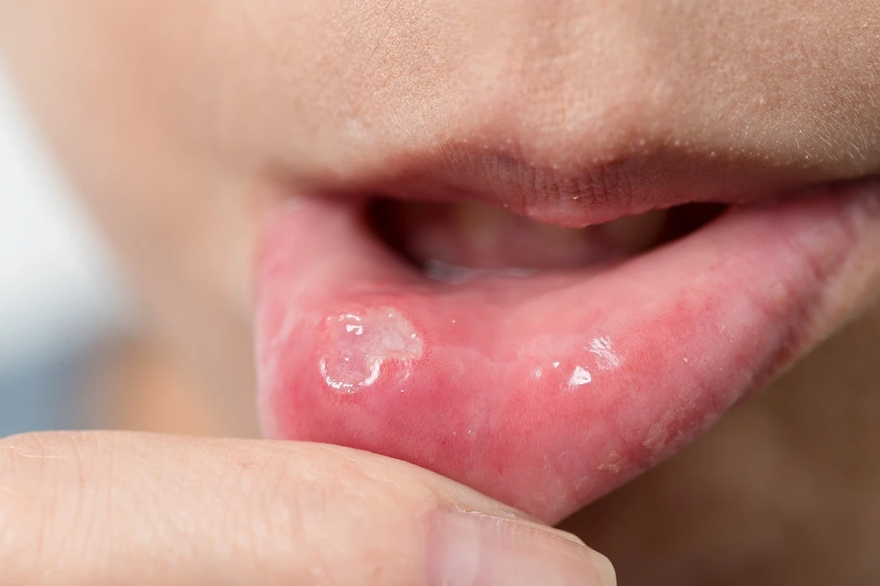 mouth-ulcer-vs-canker-sores