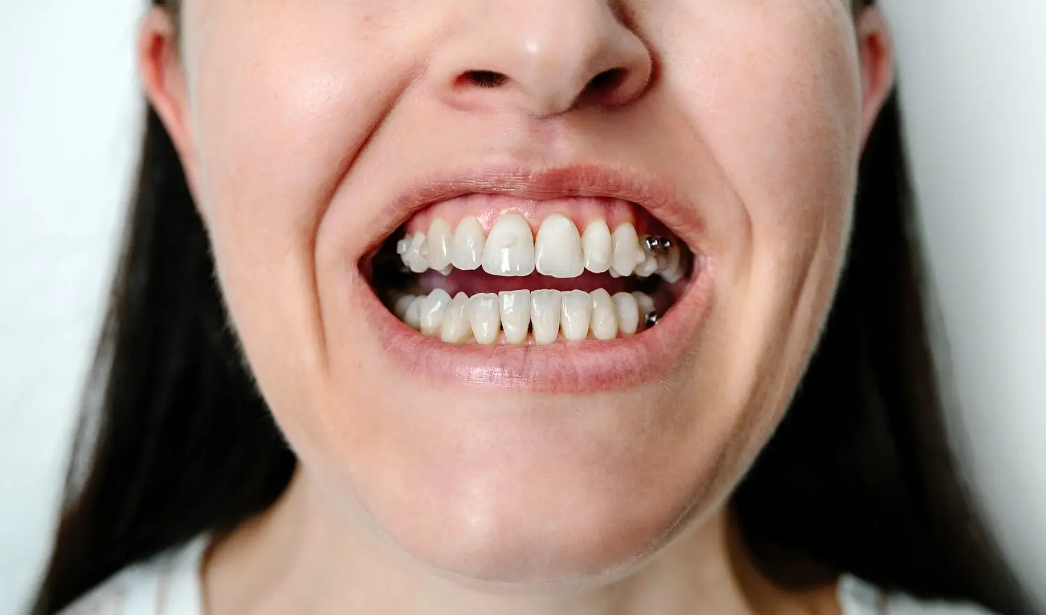 woman-with-open-mouth-showing-overbite