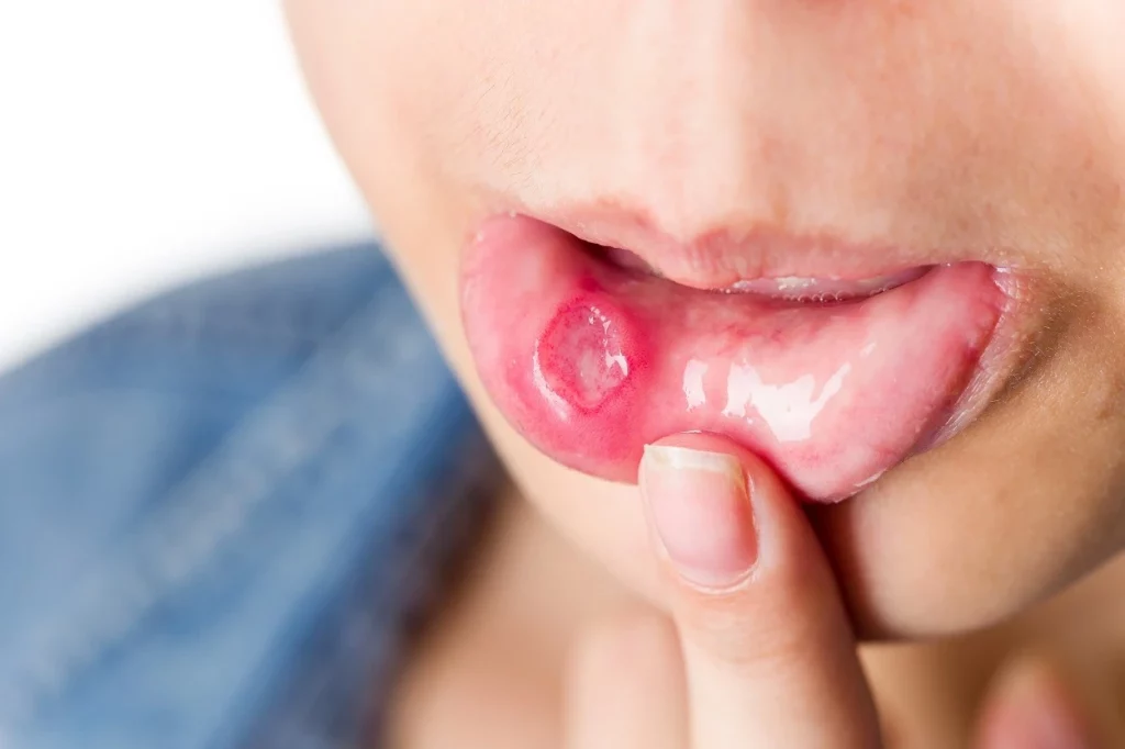 woman-with-mouth-ulcer