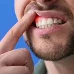 ¿Qué es un absceso dental?