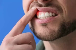 ¿Qué es un absceso dental?