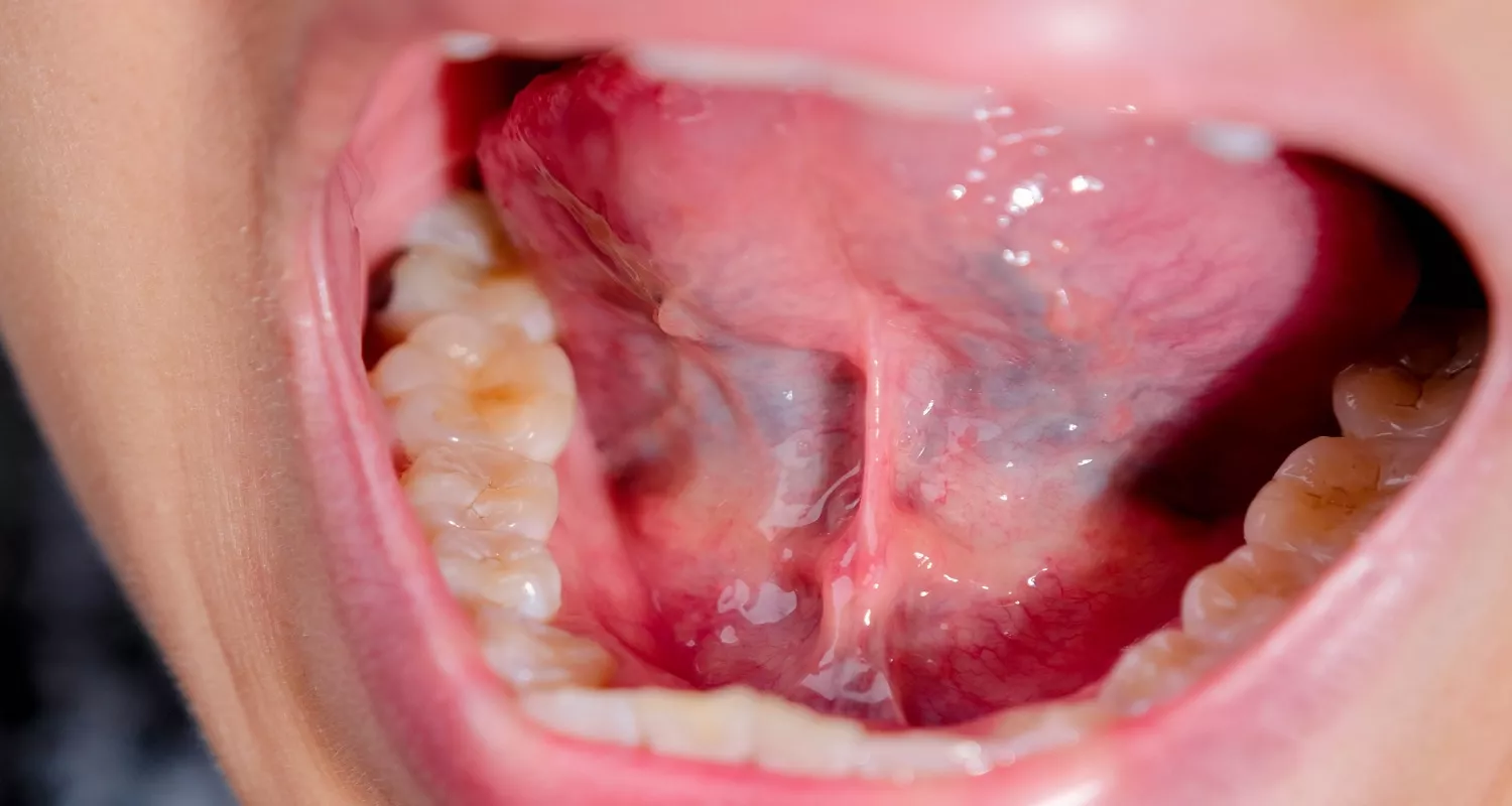 getting rid of gag reflex