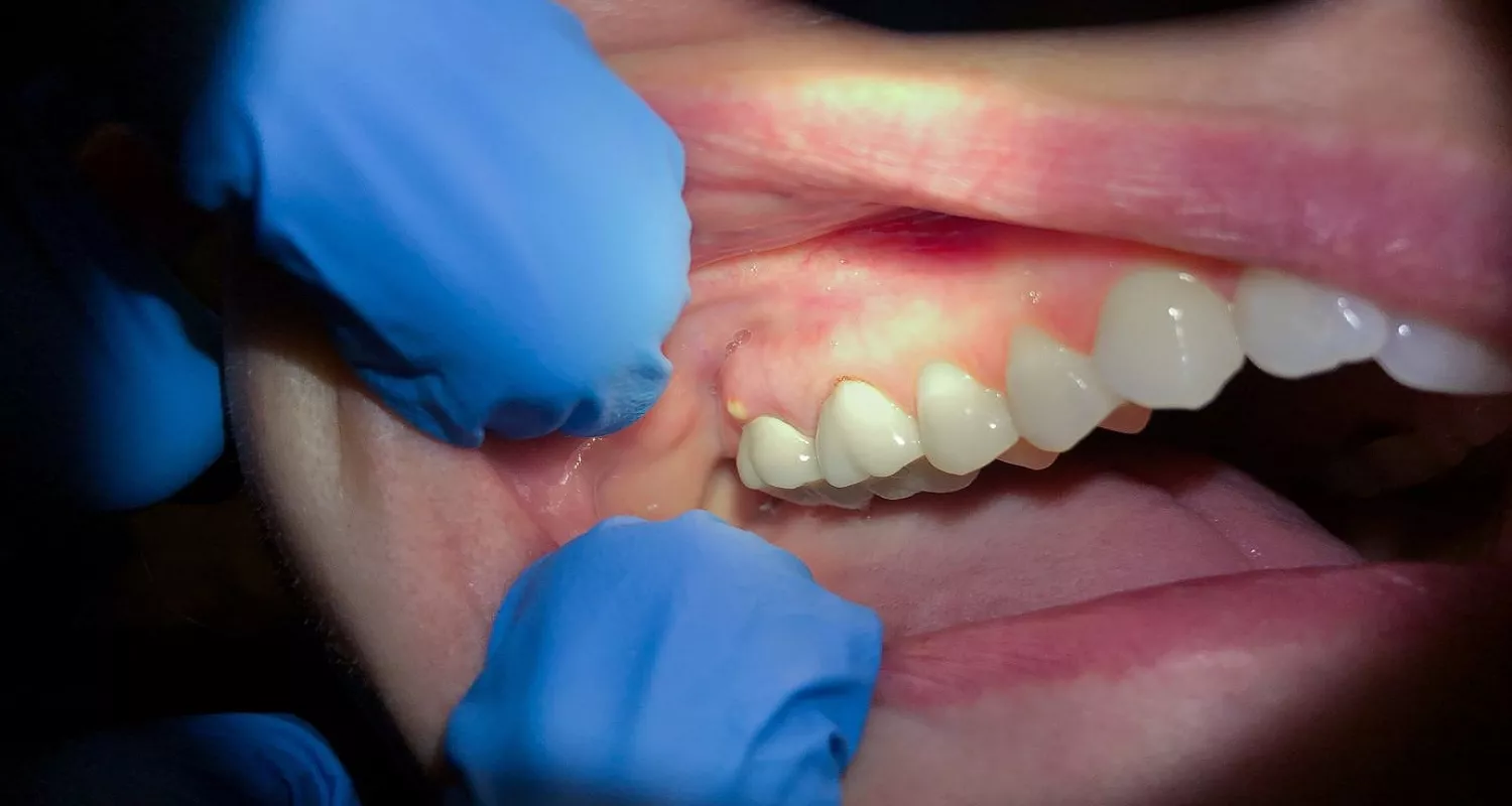 tooth abscess stages