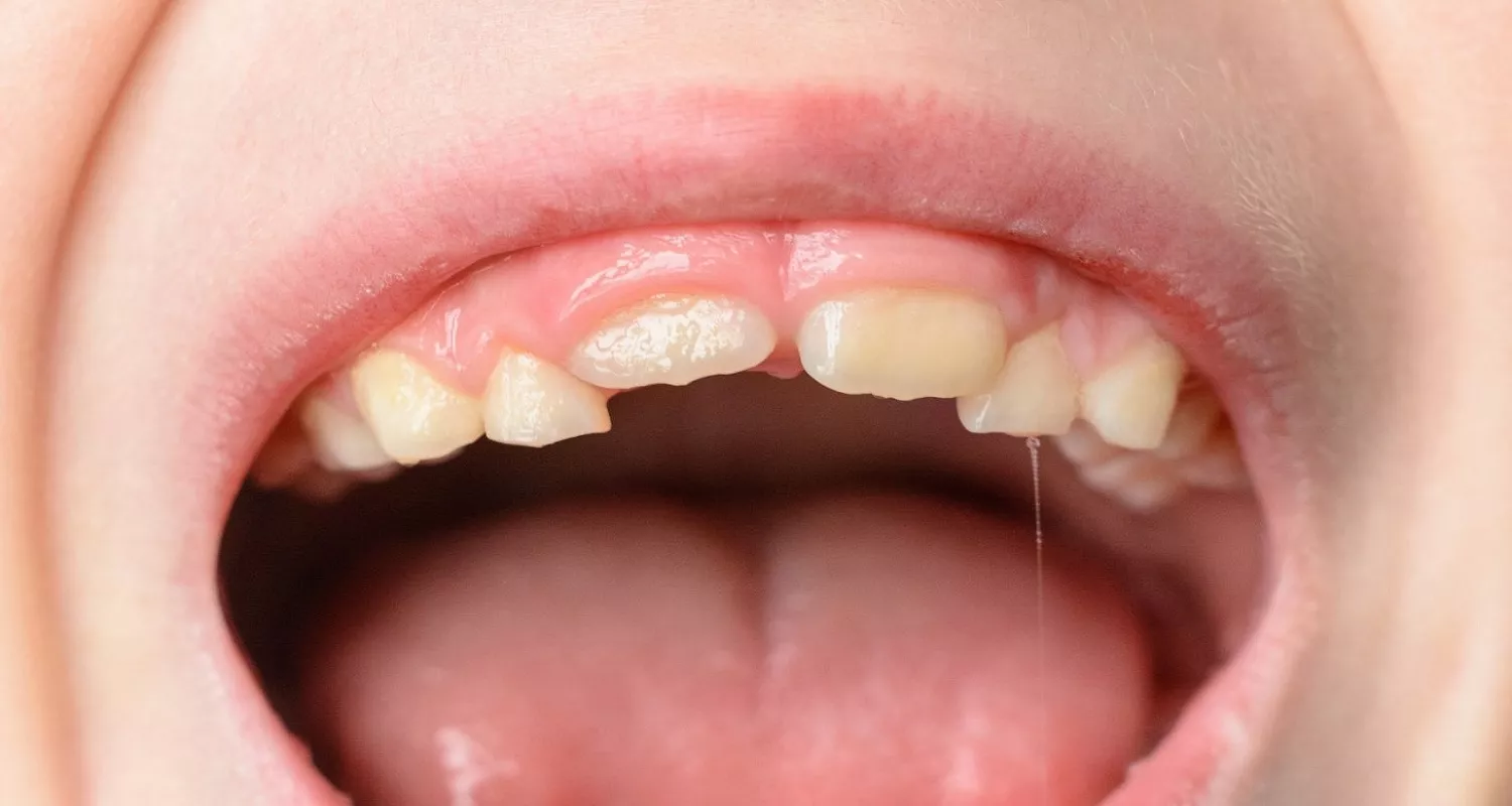 how baby teeth erupt and fall out