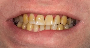 Teeth Stains