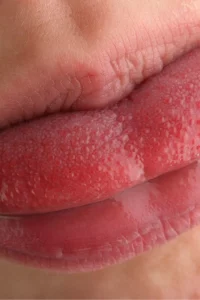 swollen-taste-buds-tongue