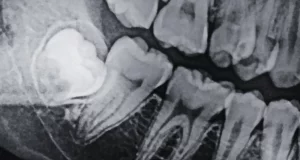 wisdom teeth coming in