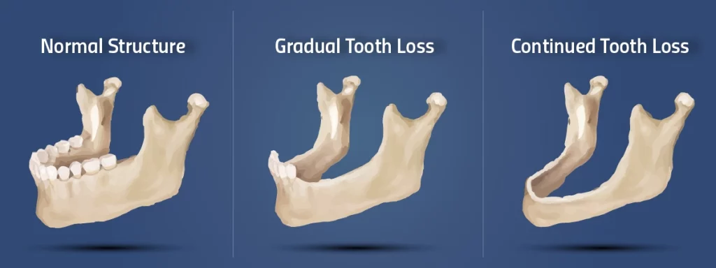 bone-loss-in-the-jaw