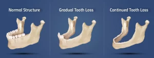 bone-loss-in-jaw