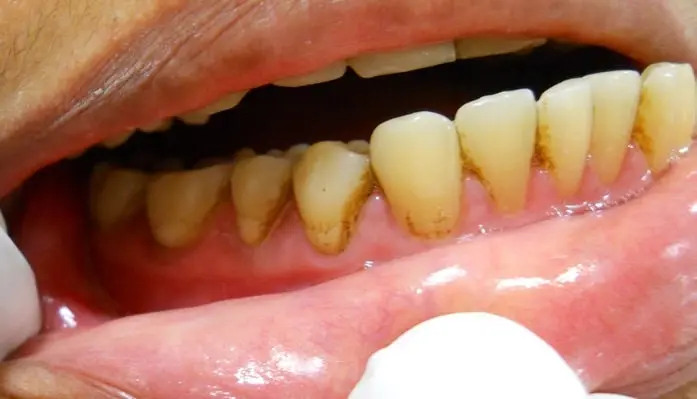 types of teeth stains