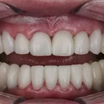 Etapas del absceso dental