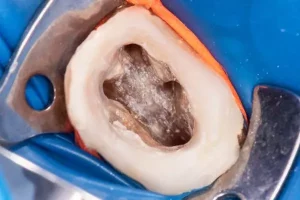 Infección del conducto radicular
