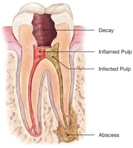 Infected-tooth