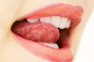 Papilas gustativas hinchadas