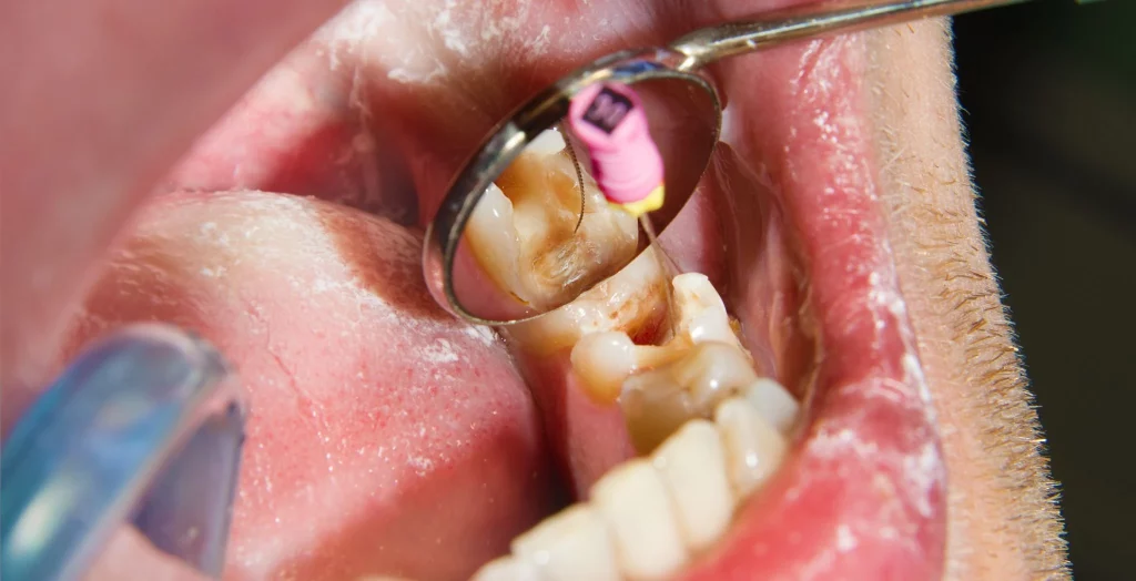 What is a Root Canal Infection? (6 Definitive Symptoms)