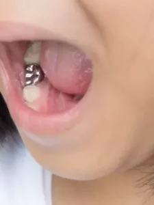 amalgam restorations