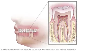 root-canal-illustration
