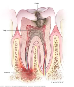 tooth-abscess