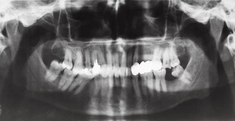 human-jaws-with-dental-crown-and-pins-in-teeth