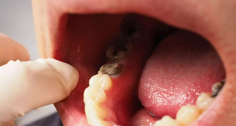 Dry Sockets