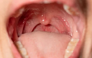 throat-showing-gag-reflex