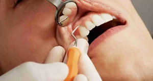 tooth abscess stages