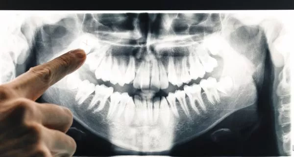What Happens When a Wisdom Tooth Is Removed?