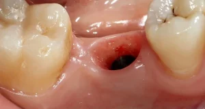 wisdom tooth hole does not close