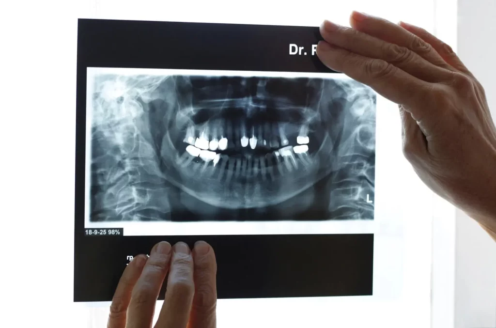 x-ray-image-of-teeth