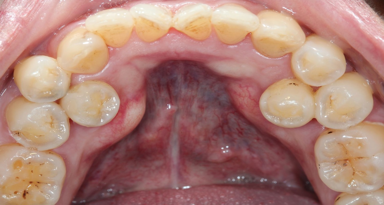 hyperdontia