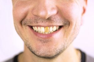 what is tooth enamel