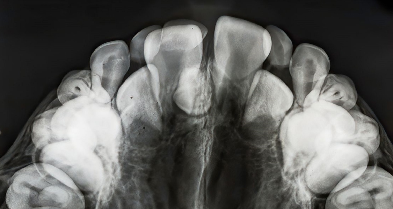 hyperdontia xray