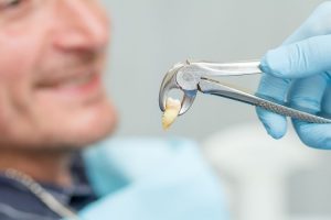 Can You Drink Alcohol After a Tooth Extraction?