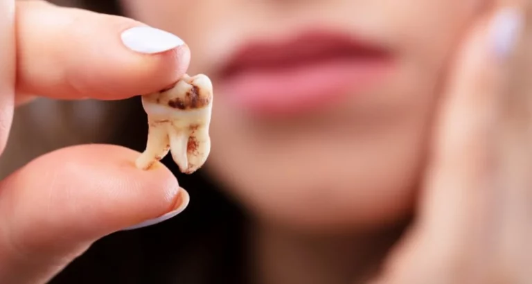 Dead tooth