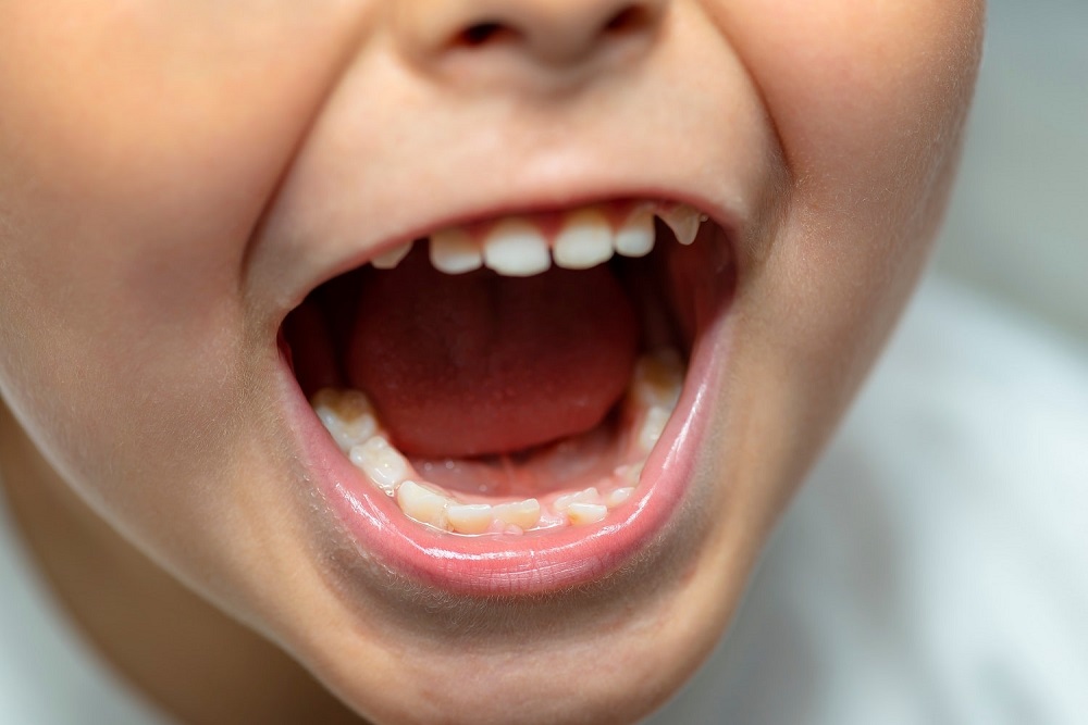 a-little-boy-with-an-open-mouth-showing-milk-teeth