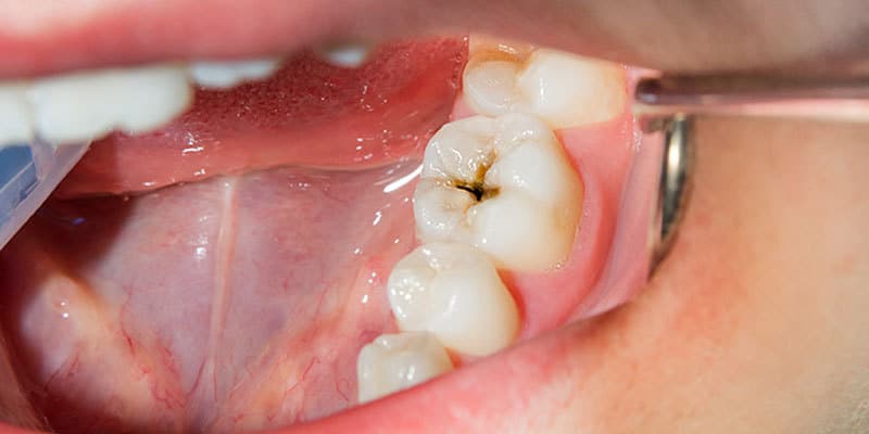 Las caries desaparecen