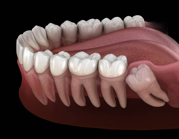 Dental Extractions