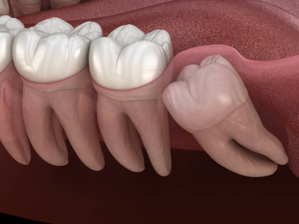 Wisdom tooth with impaction at molar tooth. Medically accurate tooth 3D illustration