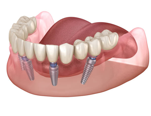 Dental implant on 4