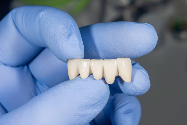 Ceramic tooth crowns and metal pins close-up macro. Orthopedic dentistry restoration decayed teeth