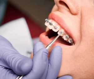 putting elastic rubber band on patient brackets