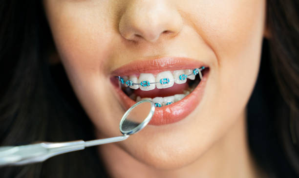 woman mouth with dental braces